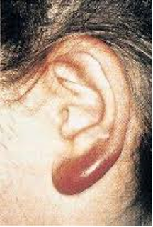 Rødt og hovent øre etter flåttbitt på barn, reaksjonen kalles borrelia lymfocytom.