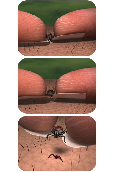 pfizer-flattvett-fjerne-flatt-uten-pinsett Fjerne flått uten pinsett. Ta tak i flåtten helt nede ved huden med neglene, dra flåtten rett ut og vask såret.